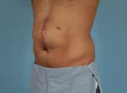 Before Image: Midline Incisional Hernia Repair - left-front-oblique