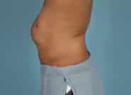 Before Image: Midline Incisional Hernia Repair - left-side