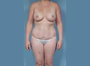 After Image: Mommy Makeover - front