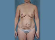 Before Image: Mommy Makeover - front