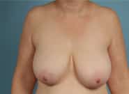 Before Image: Mommy Makeover - front