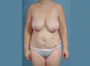 Before Image: Mommy Makeover - front
