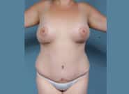 After Image: Mommy Makeover - front