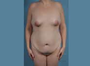 Before Image: Mommy Makeover - front