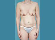 Before Image: Mommy Makeover - front