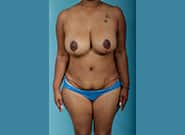 After Image: Mommy Makeover - front