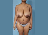Before Image: Mommy Makeover - front