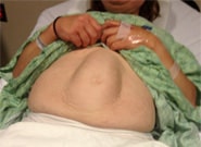 Before Image: Rectus Diastasis - front