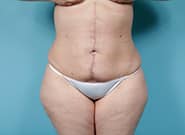 After Image: Umbilicoplasty - front