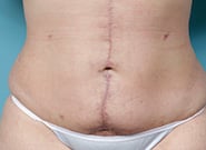 Before Image: Umbilicoplasty - front