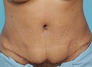 Before Image: Umbilicoplasty - front