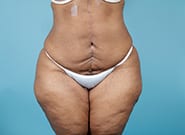 After Image: Umbilicoplasty - front