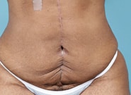Before Image: Umbilicoplasty - front