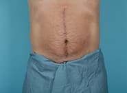 After Image: Umbilicoplasty - front