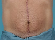 Before Image: Umbilicoplasty - front