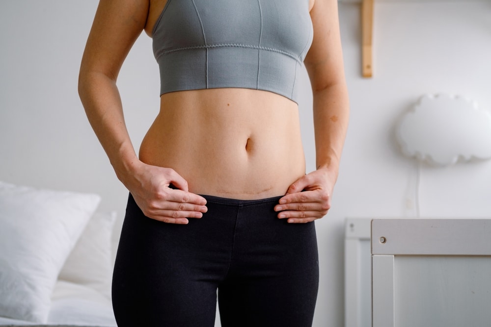 Woman, wearing yoga pants and a sports bra, positions her open hands on either side of a prominent C-section scar before her tummy tuck.