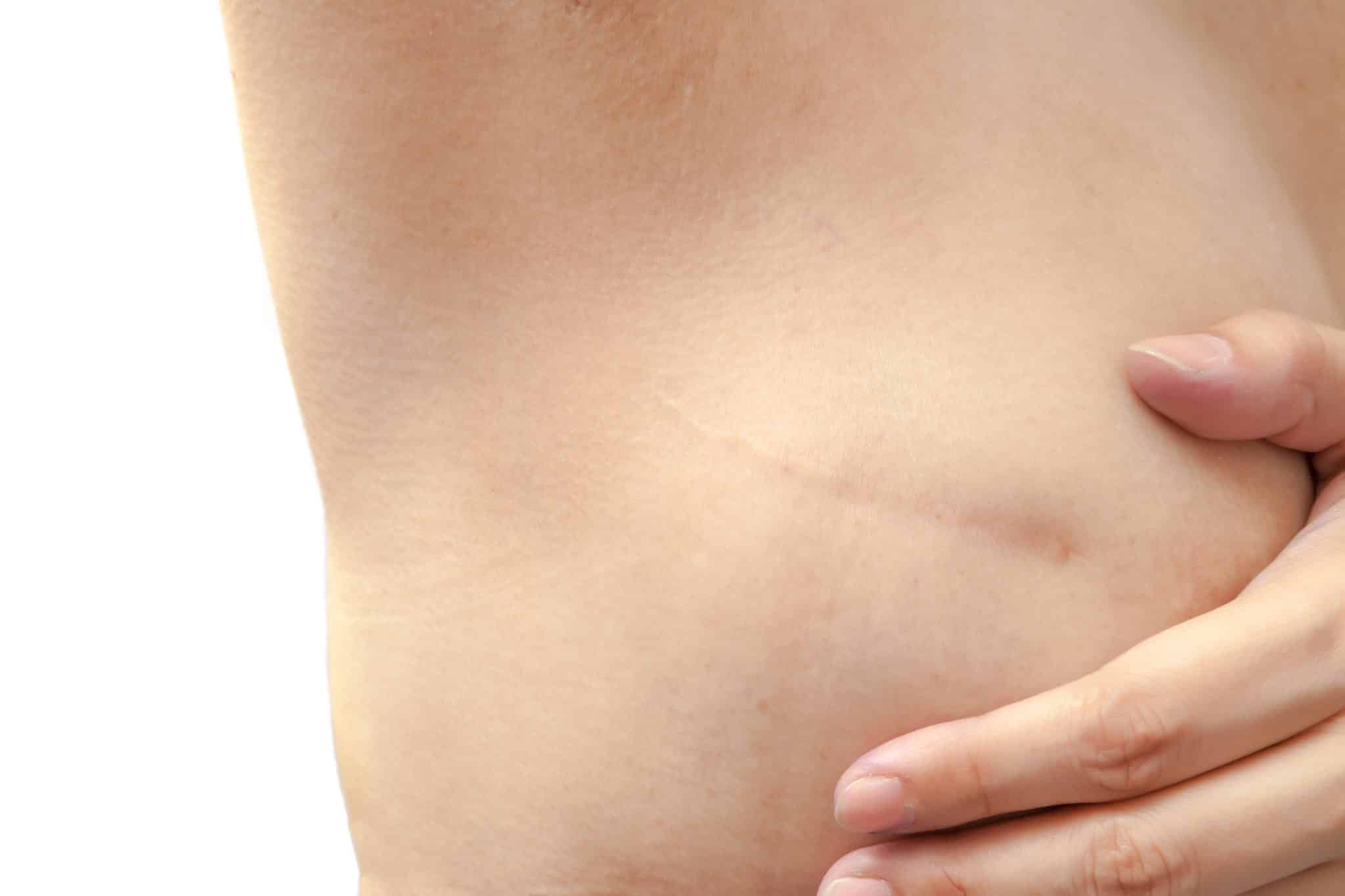 Breast reconstruction in Chicago