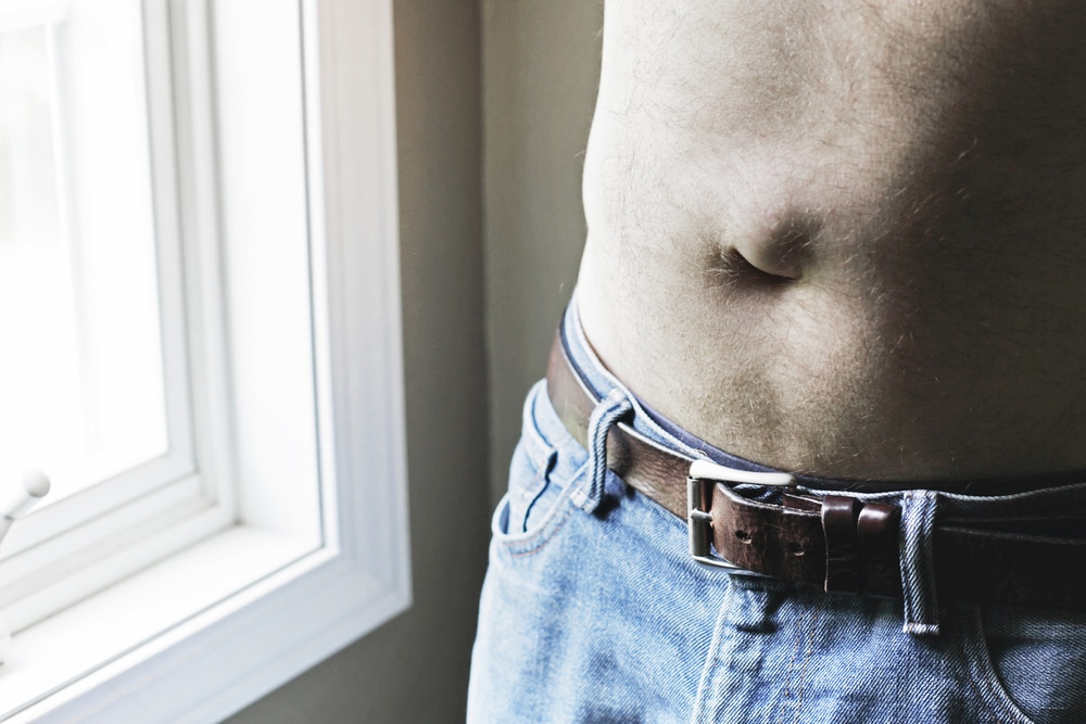 Man with an umbilical hernia, prior to abdominal hernia repair surgery